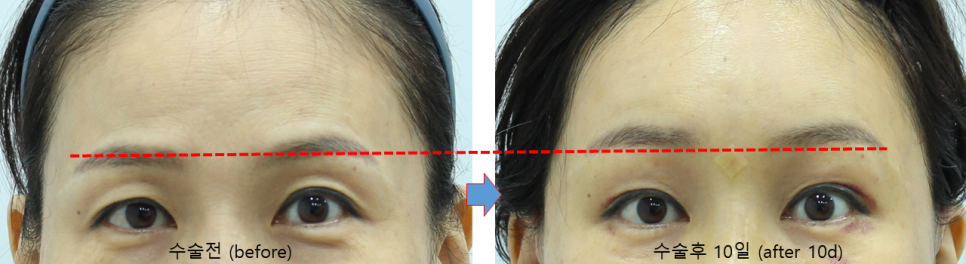 Forehead Lift to Correct Eyebrow Asymmetry image 9