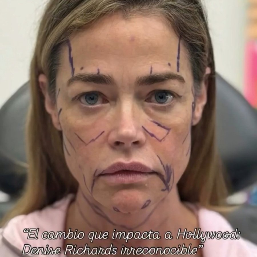 The Result of the $200,000 Anti-Aging Surgery Chosen by a Hollywood Star image 3