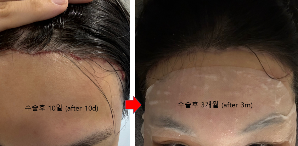 Forehead Reduction Surgery to Naturally Lower the Hairline image 4