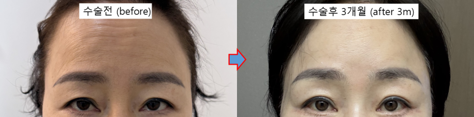 이마주름은 보톡스로 펴졌는데, 왜 눈은 더 무거워질까? 관련 이미지 4