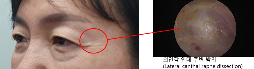 Why Horizontal Nasal Bridge Wrinkles and Eyelid Ptosis Occur Together, and the Role of Brow Lift Surgery image 3
