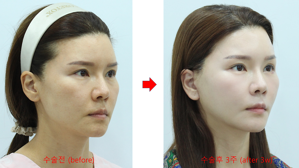 Correcting Cheek Sagging and Sunken Cheeks After Facial Contouring Surgery image 9