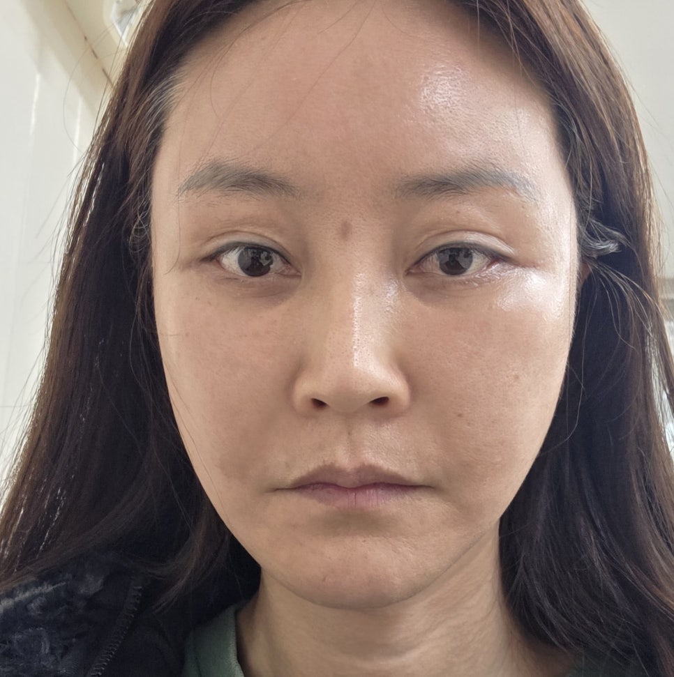 사각턱 수술 후 처진 턱라인을 개선하는 딥 미니거상 관련 이미지 5