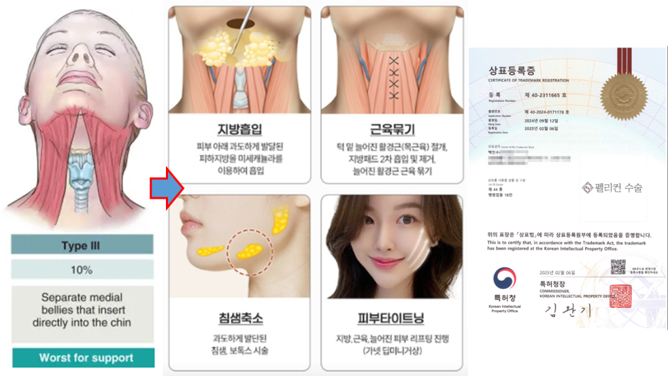 턱끝성형과 함께하는 펠리컨수술 관련 이미지 2