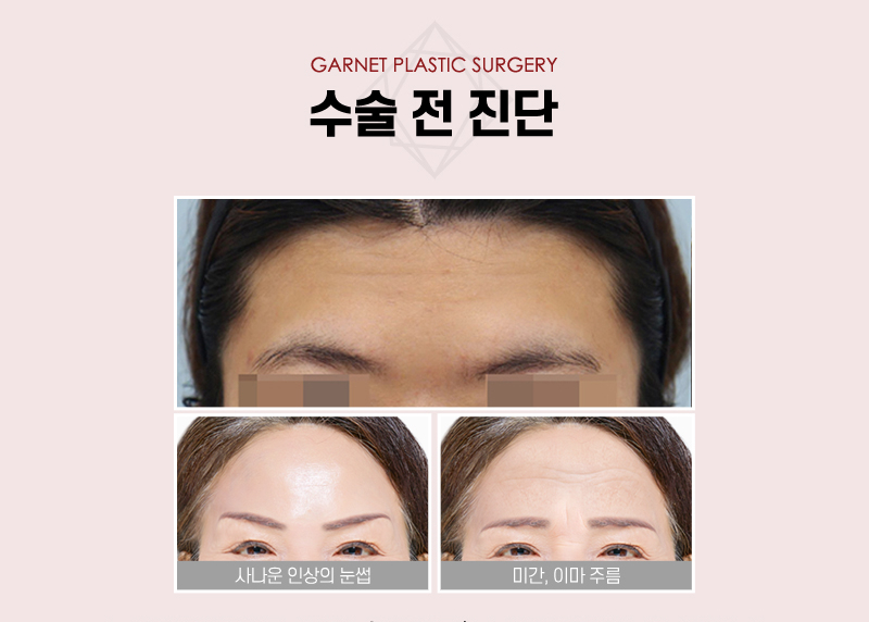 【가넷성형외과 백인수원장 성형칼럼】 20대 여성 펜타픽스 이마거상으로 이마 모양과 눈썹 교정 관련 이미지 3