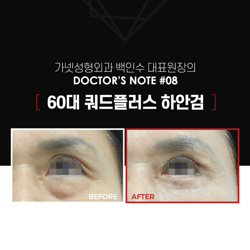 【가넷성형외과 백인수원장 성형칼럼】 60대 쿼드플러스 하안검 수술 관련 이미지 2