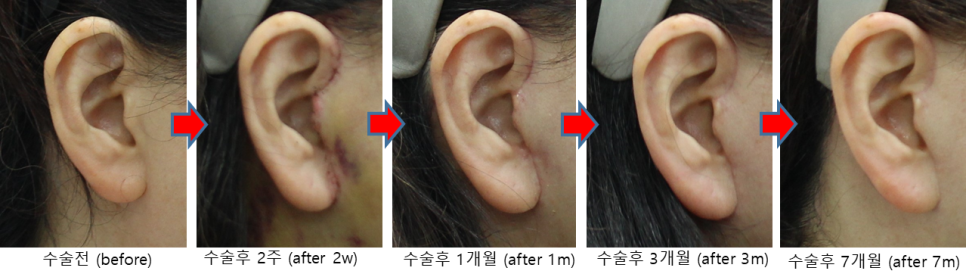 안면거상, 긴 절개선인데 흉터가 눈에 잘 띄지 않는 이유 관련 이미지 3