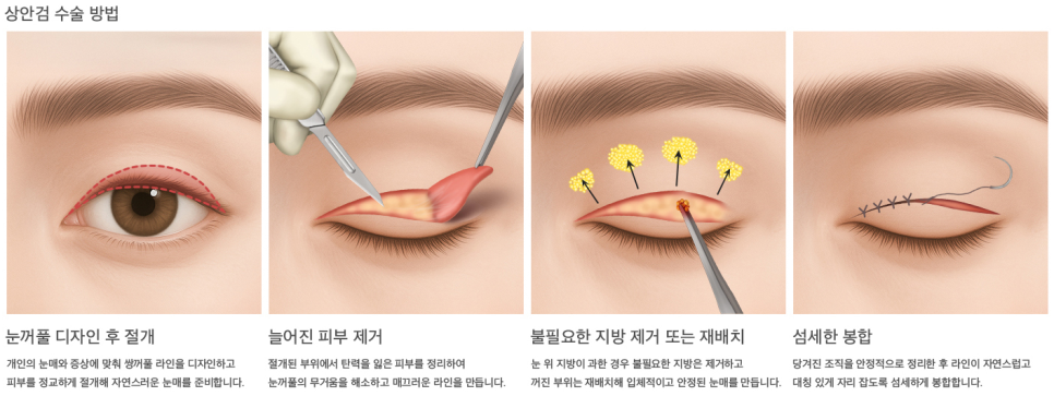 Recovery Process and Natural Impression Changes After Upper and Lower Eyelid Surgery in a Man in His 50s image 1