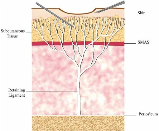 A Specialized Fat Grafting Correction Method for Hollowed Side Cheeks image 5
