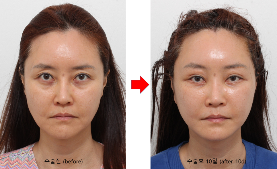사각턱 수술 후 처진 턱라인을 개선하는 딥 미니거상 관련 이미지 2
