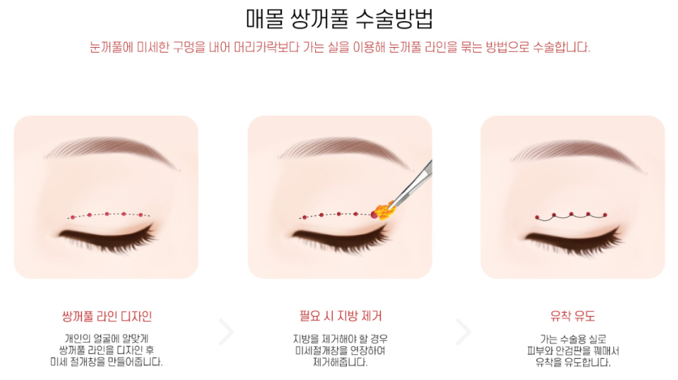 First-Eye Surgery with a Non-Incision Method (Buried Suture Double-Eyelid Surgery) image 2