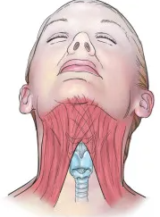 Submental Incision Neck Lift Performed Together with Facelift image 5