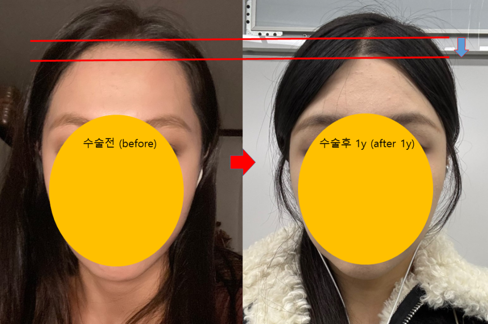 Forehead Reduction Surgery to Naturally Lower the Hairline image 5