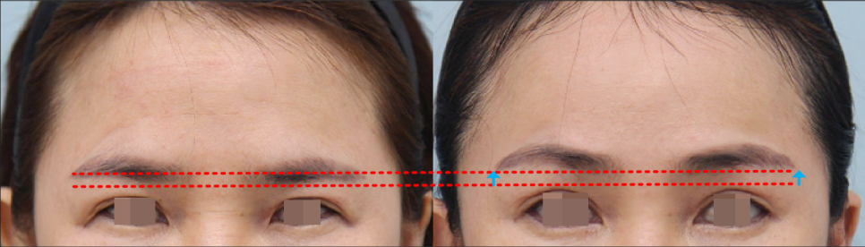 A Forehead Lift Is Essential When the Upper Eyelids Are Thick image 5