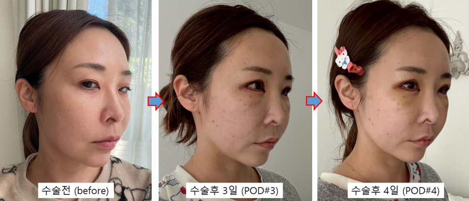 동안과 여성스러움을 동시에, 자연스러운 변화를 만드는 지방이식 관련 이미지 3