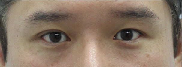 Types of Under-Eye Hollowness and Correction Methods image 6