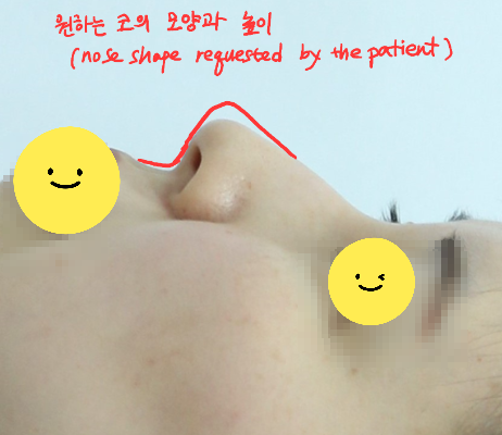 자연스러운 변화를 위한 무보형물 코성형 관련 이미지 2
