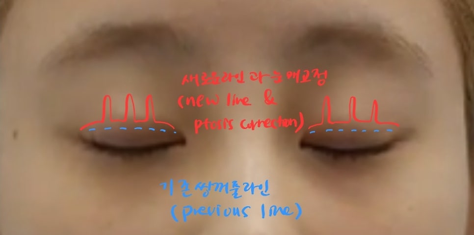 Non-incisional Eye Correction in Revision Surgery for Buried-Method Double Eyelids image 11