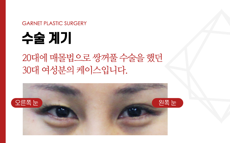 【Garnet Plastic Surgery Director Baek In-soo’s Plastic Surgery Column】 Eye Correction for a Rounder, Kinder Eye Shape image 3