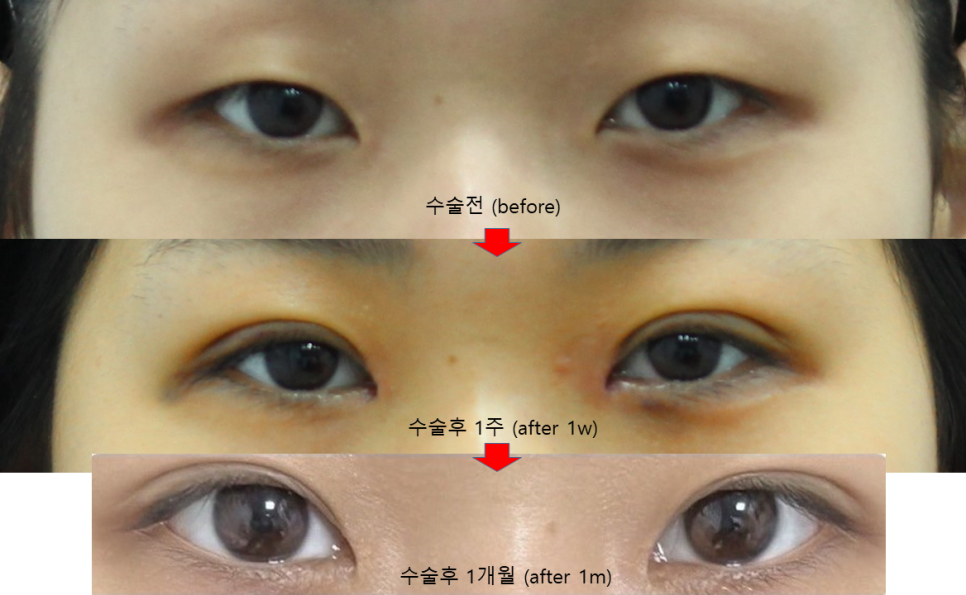 First-Eye Surgery with a Non-Incision Method (Buried Suture Double-Eyelid Surgery) image 4
