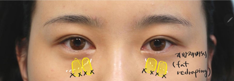 Lateral and Lower Canthoplasty with Under-Eye Fat Repositioning image 3