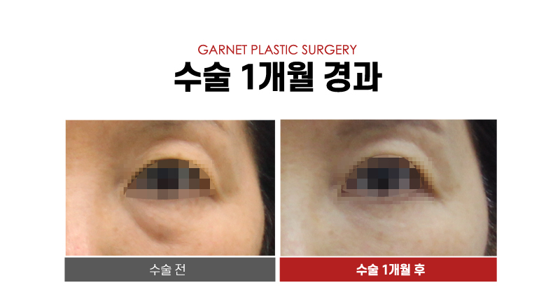 【Garnet Plastic Surgery Director Insoo Baek’s Plastic Surgery Column】 Lower Blepharoplasty Case in a Woman in Her Late 50s image 6
