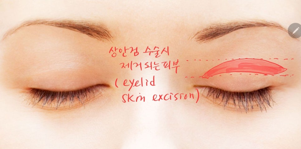 자연스럽고 부담이 적은 눈썹하거상 관련 이미지 1