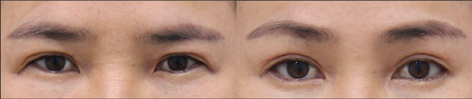 A Forehead Lift Is Essential When the Upper Eyelids Are Thick image 4