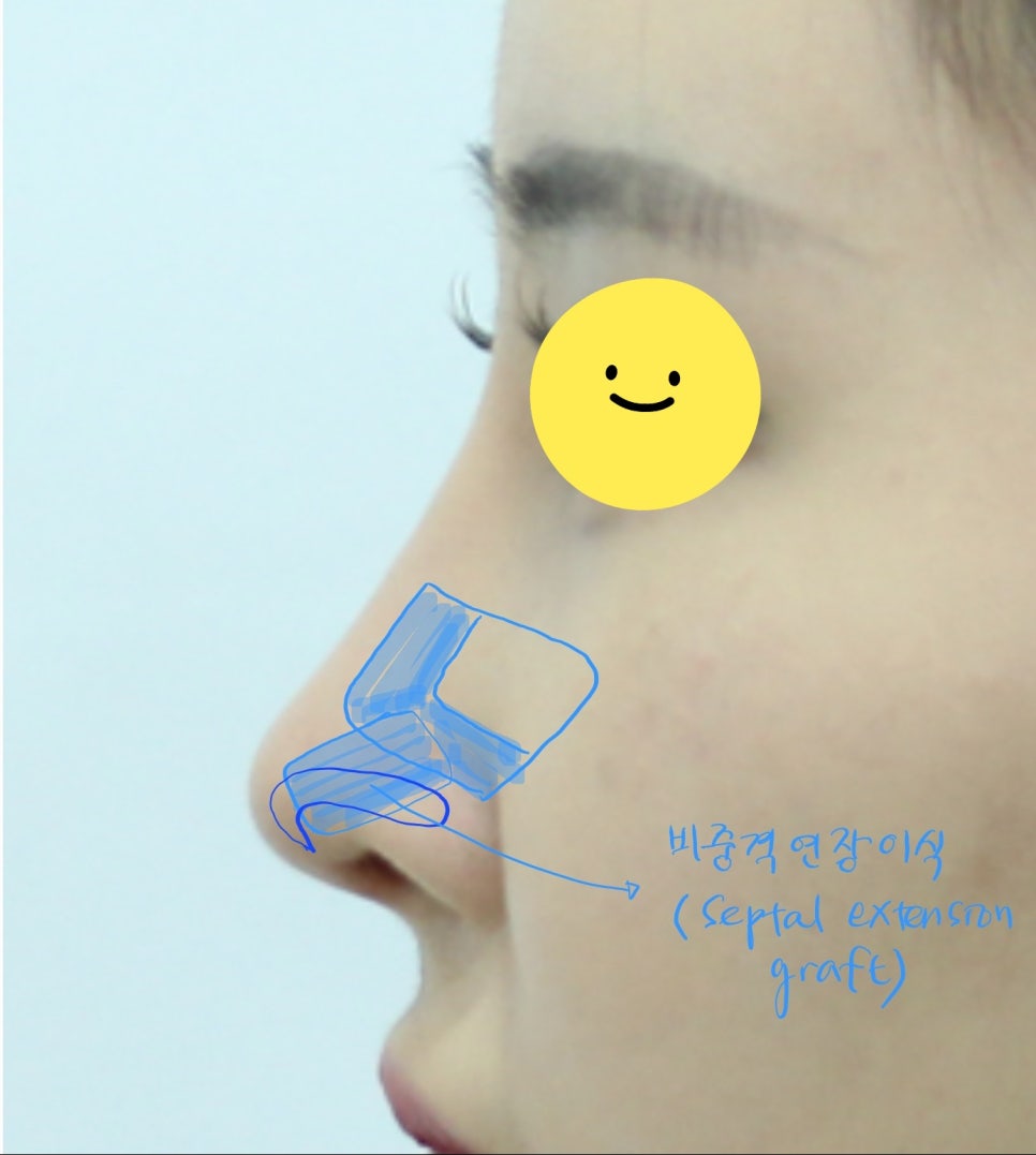 코성형에서 비중격 연골과 귀연골의 용도 관련 이미지 6