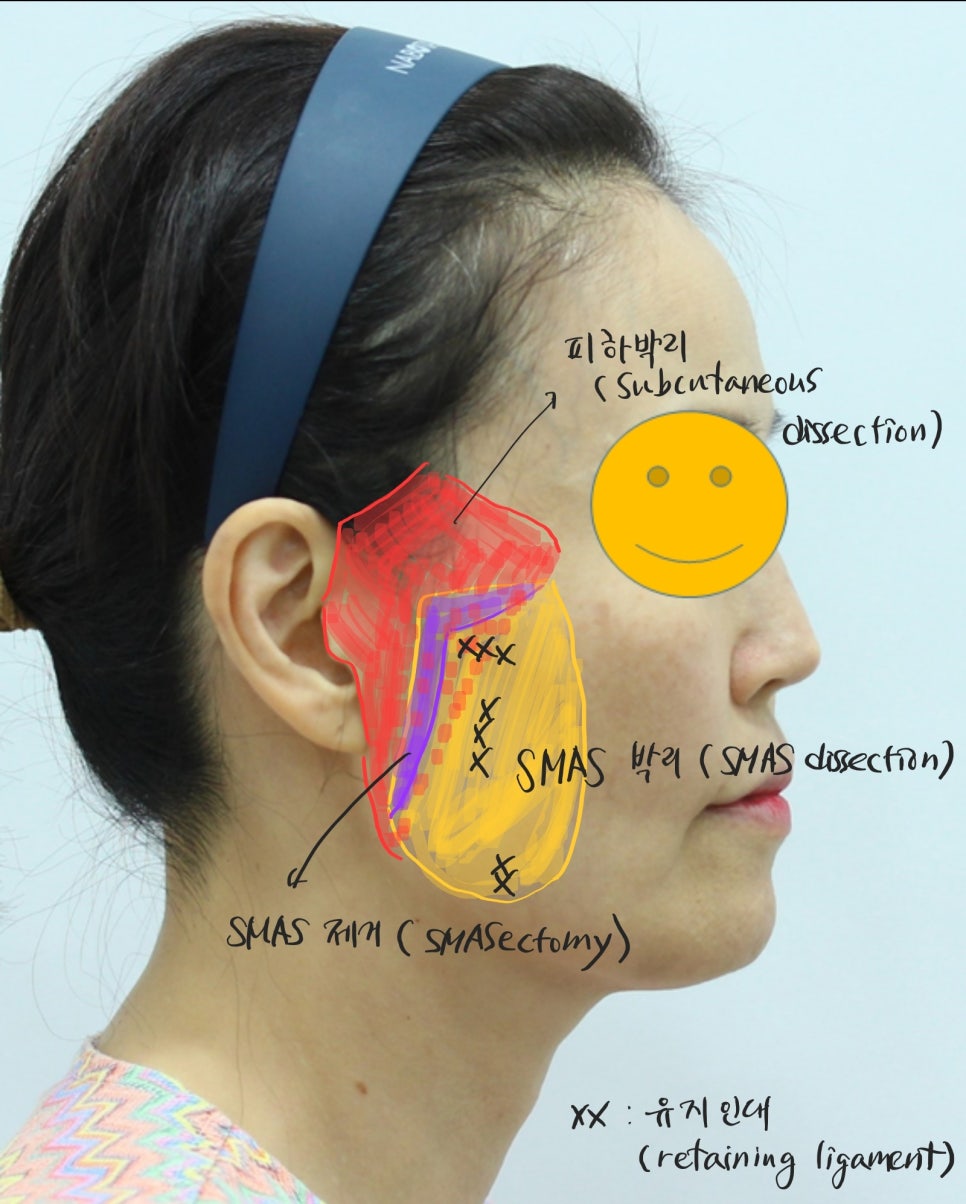 딥미니거상의 절개선과 귀모양의 보존 관련 이미지 3