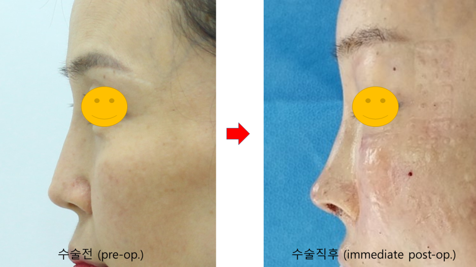 코끝연골이 비치는 경우 중년코재수술 관련 이미지 7