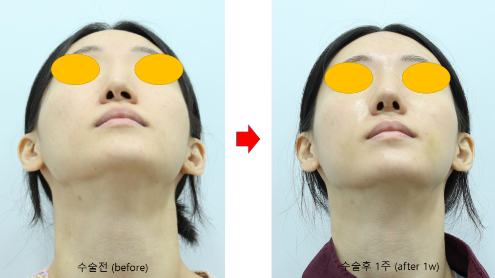 Various Surgical Methods for Crooked Nose Surgery image 7