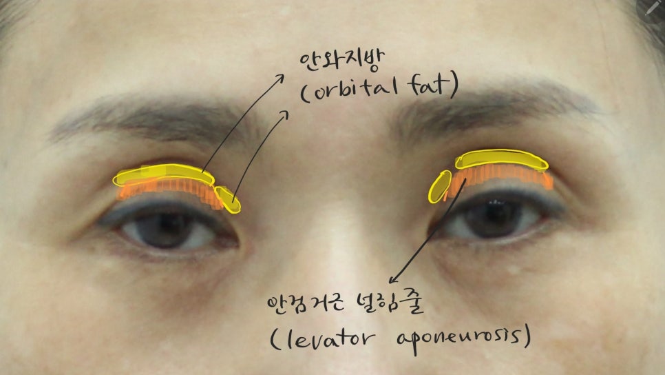 꺼진눈 쌍꺼풀 수술에서 필요한 눈위지방재배치 관련 이미지 3