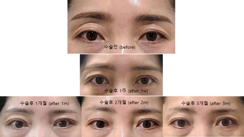 How to Address Double Eyelids and Hollow Eyes by Improving Both the Line and Volume image 5
