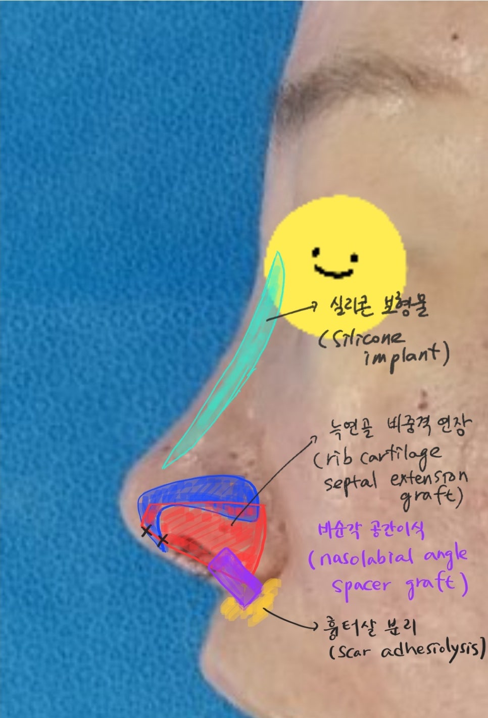 늑연골을 이용한 비주함몰의 교정 관련 이미지 8