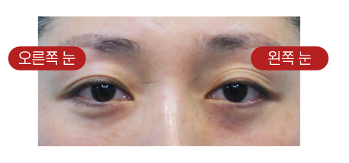 【가넷성형외과 백인수원장 성형칼럼】 쌍꺼풀재수술 (겹주름제거와 눈매교정술) 케이스 관련 이미지 3