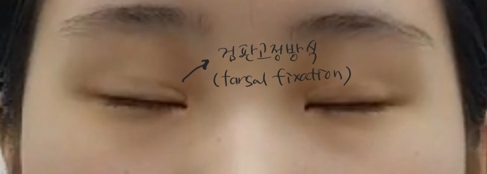 안검하수가 동반된 짝눈의 쌍꺼풀 재수술 관련 이미지 4
