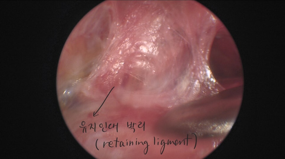 상안검 성형과 이마거상을 함께 했을 때 장점 관련 이미지 8