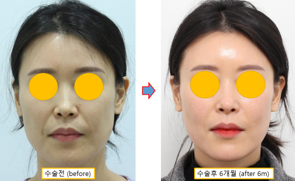 얼굴 지방이식 유지기간, 3·6·9개월 경과로 알아보는 생착과정 관련 이미지 5