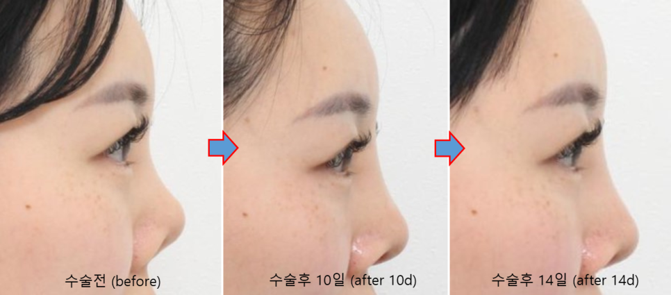 늑연골로 만든 콧대, 정말 흡수될까요? 관련 이미지 4