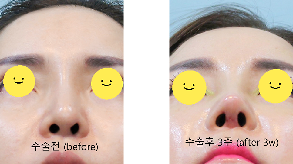 트렌드 변화에 따른 중년코 재수술 관련 이미지 8