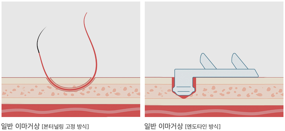 이마거상술 고정법, 엔도타인과 실고정 중 무엇이 더 좋을까요? 관련 이미지 1
