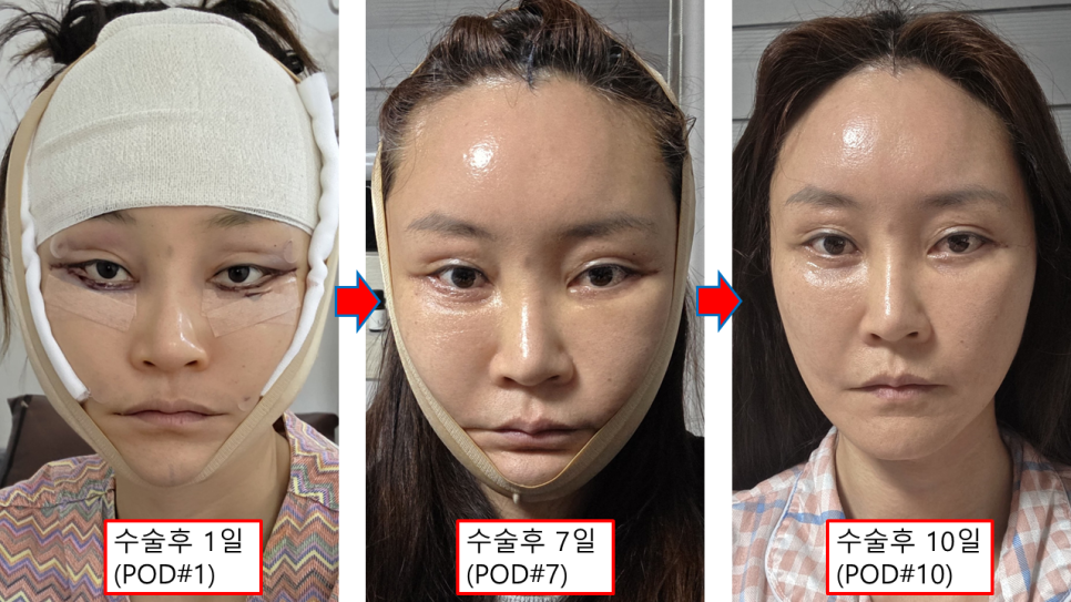 안티에이징 수술 후 회복과정 안내 관련 이미지 1