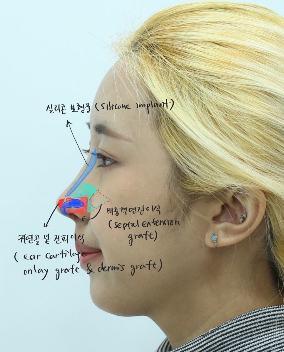 첫번째 코성형, 첫코성형, 20대 코성형 관련 이미지 6