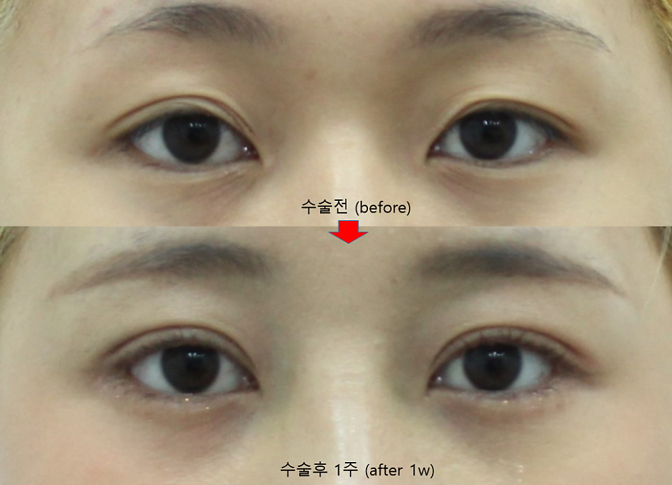 First-Eye Surgery with a Non-Incision Method (Buried Suture Double-Eyelid Surgery) image 5