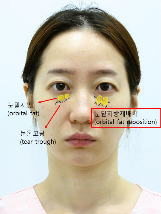 직장인들에게 가장 인기있는 성형 항목 관련 이미지 2