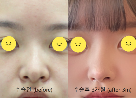 Nasal Tip Remodeling for Bulbous Nose and Drooping Columella Correction image 7