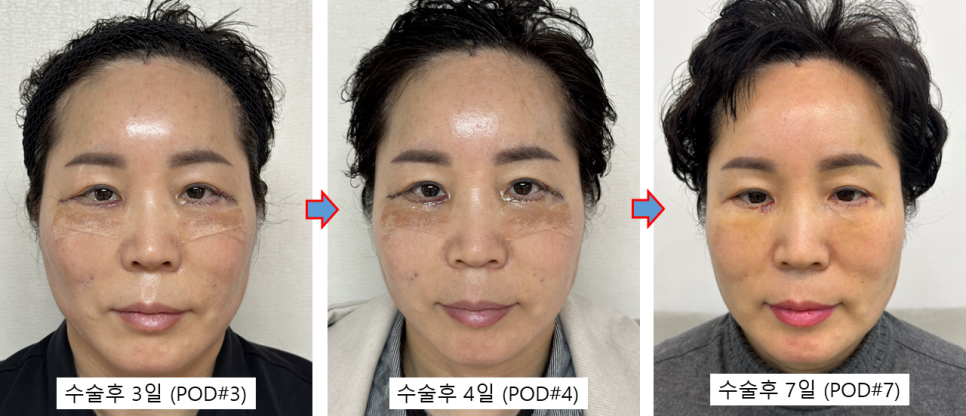 Mother’s Day Top Pick for a Gratitude-Driven Facial Procedure: The Recovery Process After Lower Blepharoplasty A to Z image 2