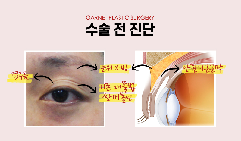 【가넷성형외과 백인수원장 성형칼럼】 쌍꺼풀재수술 (겹주름제거와 눈매교정술) 케이스 관련 이미지 4
