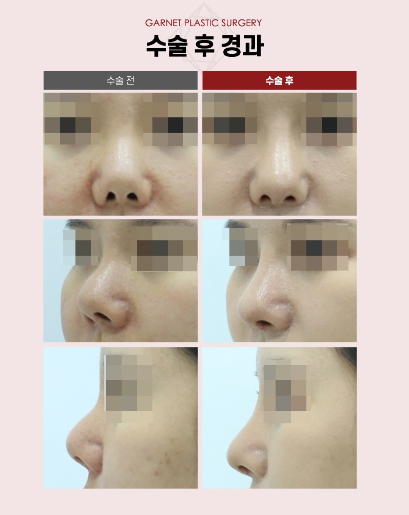 【Garnet Plastic Surgery Director Baek Insoo’s Plastic Surgery Column】 Rib Cartilage Contracted Nose Revision Surgery (Removal of Nose Implant) image 7